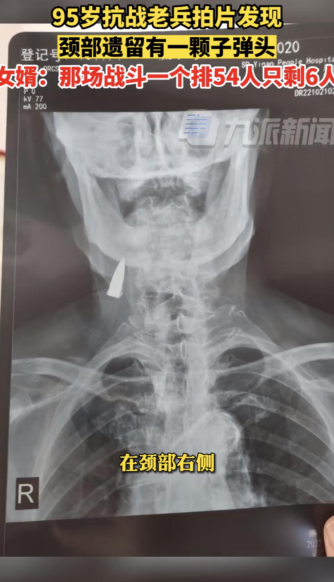 95岁抗战老兵拍片发现颈部有子弹头，致敬!