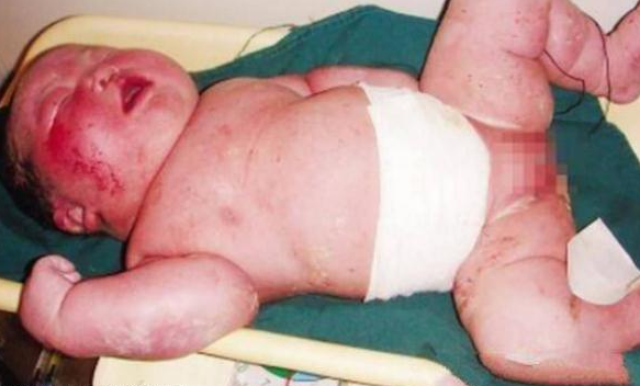 世界上最大的婴儿有多重：澳大利亚巨婴(36斤)