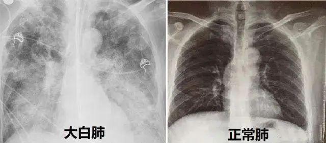 张文宏解读为何觉得白肺变多了