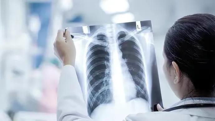 肺部CT需求暴增 检出率约10%-20%